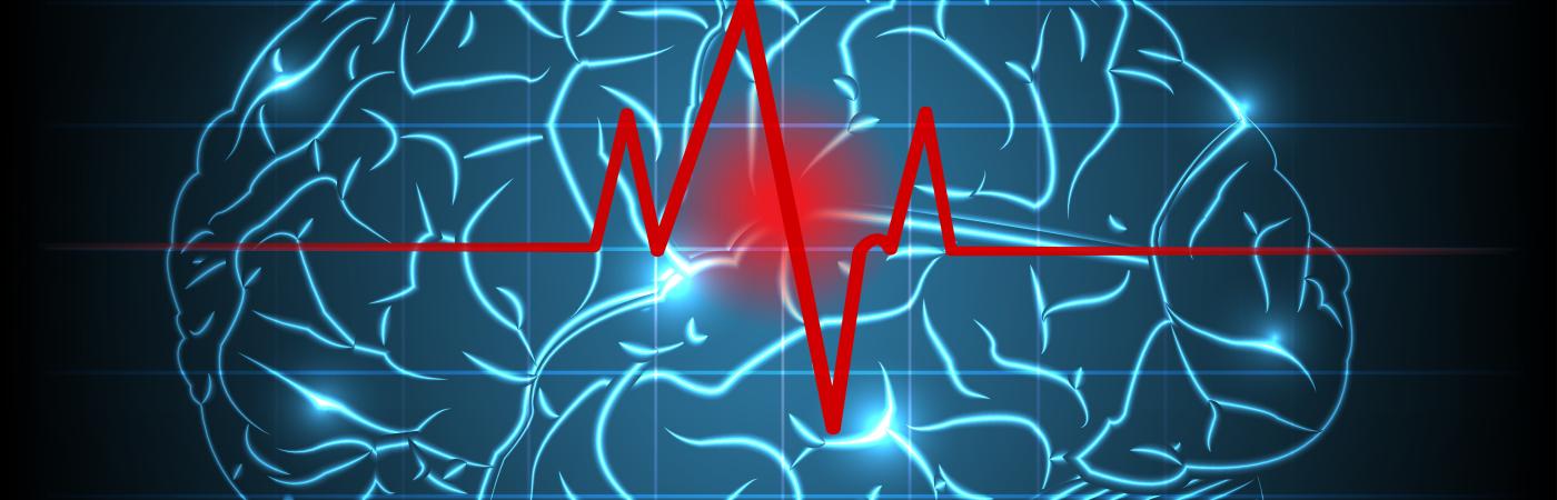 stroke brain image