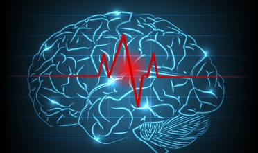 stroke brain image
